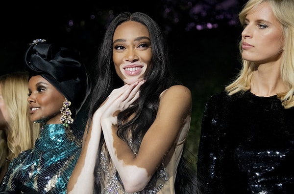 9. Как называется нарушение пигментации, выражающееся в исчезновении пигмента меланина на отдельных частях кожи?