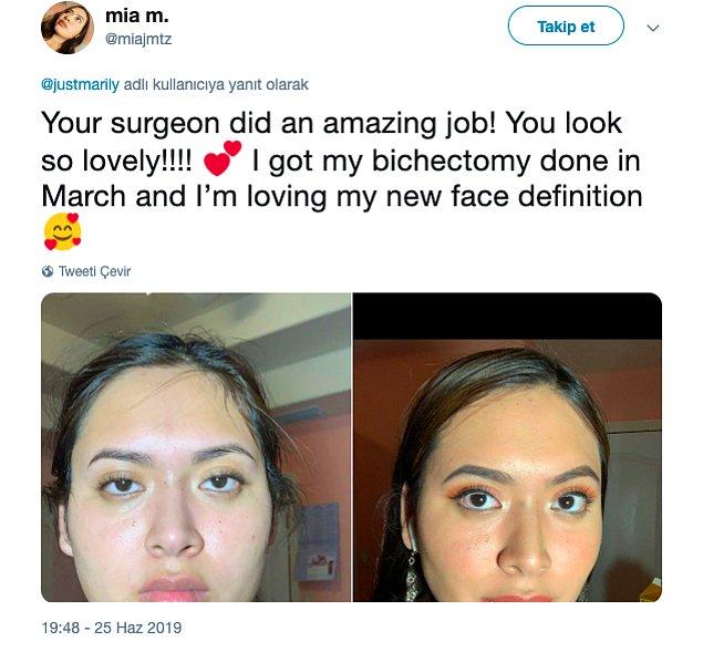 14. "Cerrahın harika bir iş çıkartmış! Çok güzel gözüküyorsun!!! Mart'ta bişektomi yaptırdım ve yeni yüz ifademi çok sevdim."