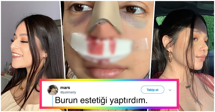 Göründüğü Kadar Kolay Değilmiş! Burun Estetiği Yaptırdıktan Sonra Bambaşka Birine Dönüşen İnsanlar