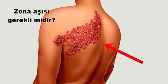 Su Çiçeği Çıkaran Herkesin Mutlaka Bilmesi Gereken Zona Hastalığı Hakkında Merak Edilen Soru ve Cevaplar