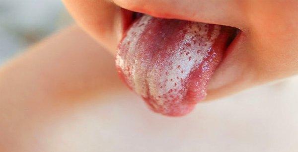 Bu belirtileri gördüğünüz zaman çocuğunuzun çenesinden tutarak ağzını açmasını sağlayın ve ağız içini kontrol edin.
