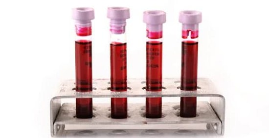 Kanımızdaki Değer Hakkında Bilgi Sağlayan Sedimantasyon Nedir?