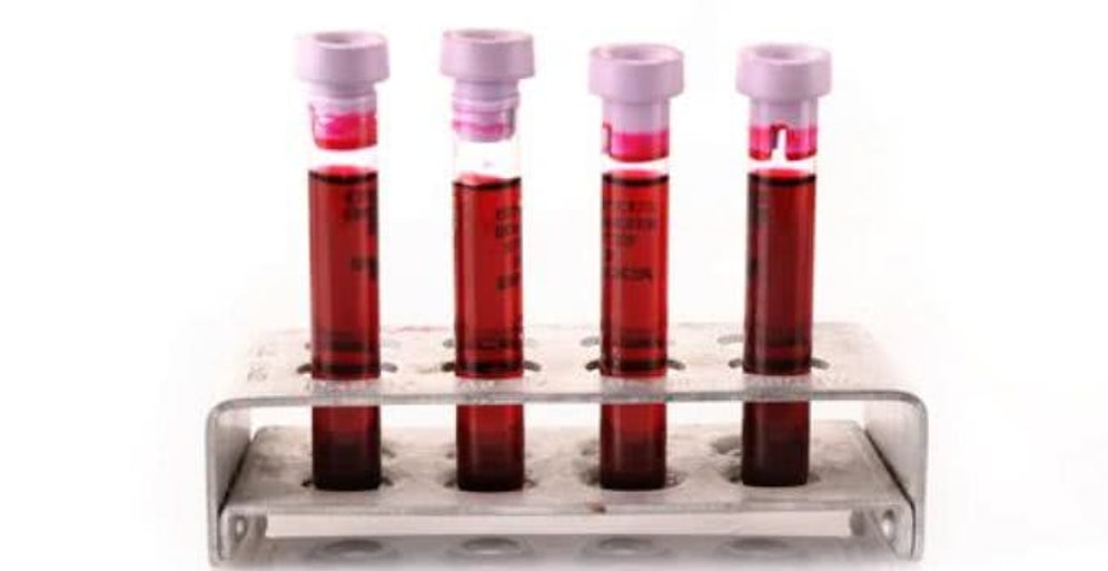 Kanımızdaki Değer Hakkında Bilgi Sağlayan Sedimantasyon Nedir?