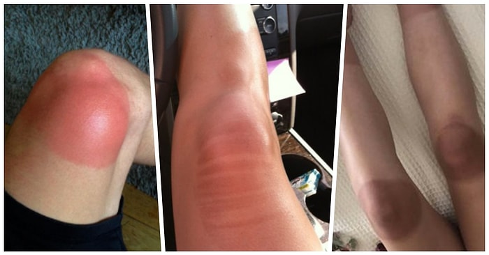 Bu Sıcaklarda Yırtık Pantolon Giyip Şekilli Yanarak Hayatlarının Hatasını Yapmış 11 Kişi