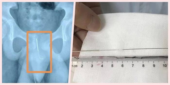 Okul Takıntısı Olan 13 Yaşındaki Çocuk, Ödevlerini Yaparken Uyuyakalmamak İçin Penisine 10 Santimetrelik İğne Soktu!