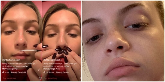 Gençler Arasında Hızla Yayılıyor: Sosyal Medyada Dudakları Tutkalla Yapıştırarak Büyük Gösterme Akımı