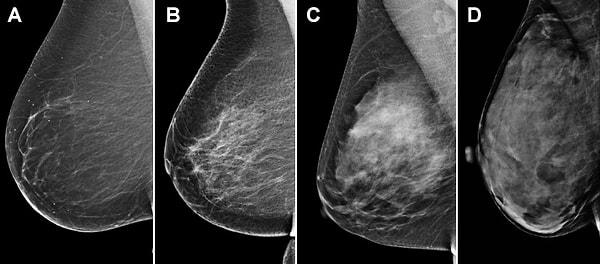 Radyologlar, yoğun olan ve yoğun olmayan doku oranına dayanarak meme dokusunu derecelendirmek için mamografi görüntüleri kullanır.