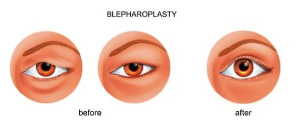 Öncelikle ameliyat olmayı seçecekseniz, alt ve üst göz kapaklarının şeklini ve estetiğini ilgilendiren ameliyatların tıbbi isminin "Blefaroplasti" olduğunu bilmelisiniz.