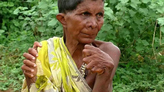 63 yaşındaki Kumar Nayak, polidaktili isimli normalden daha fazla parmaklara sahip olmasına sebep olan nadir bir hastalıkla dünyaya geldi.