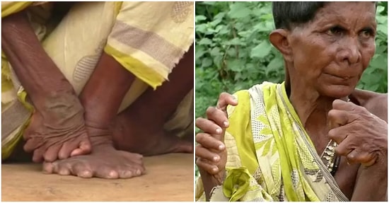 Fazla Parmak Hastalığı Olarak da Bilinen Polidaktili'den Dolayı Komşularının Cadı Sandığı 'Kumar Nayak'