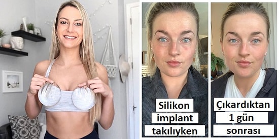 Silikon Taktırmayı Düşünen Kadınların Pek Çoğunun Bilmediği Acı Gerçek: Silikon İmplant Hastalığı