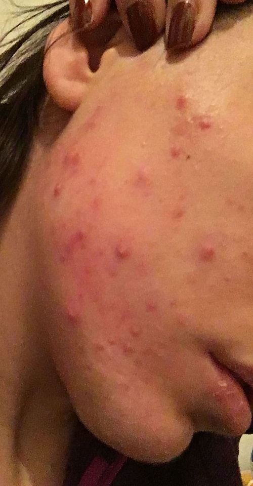 27 yaşında yüz temizliğine aşırı derecede dikkat eden, makyaj gerekmedikçe yapmayan, asla makyajlı bir şekilde uyumayan ve en iyi markaları kullanmaya özen gösteren bir kadınım. Fakat bu dikkatim, çabam kistik sivilcelerin çıkmasına engel olmadı.