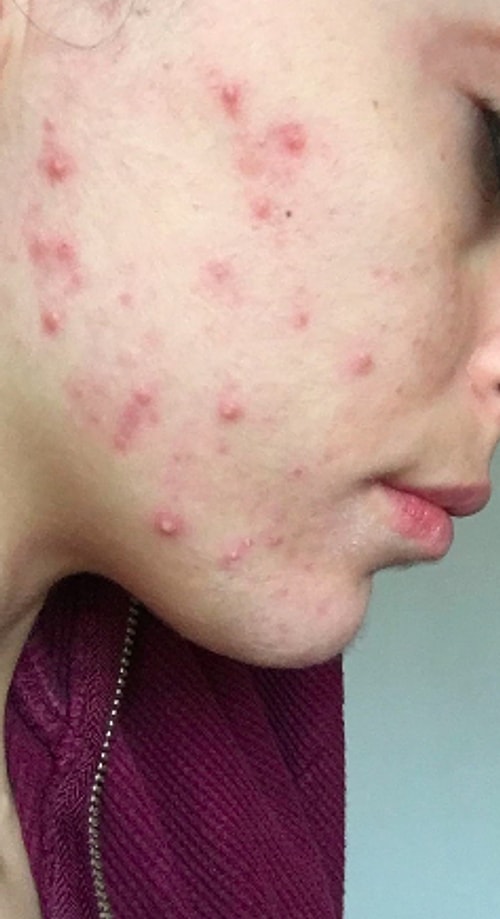 Fotoğraflarda belki çok net değil ama şu anki halim bu. Ocak ayının ilk haftası tekrar gidip karaciğer testi yaptıracağım ve sonuca göre ilaca devam edeceğim. İlk ayım bu şekilde geçti, 2. ay daha ağır geçecek gibi. Şimdilik ocak sonunda görüşmek üzere... 😎