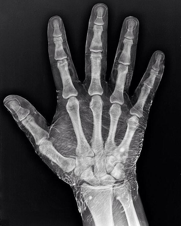 15. İyota batırılmış bir el röntgeni... İyot x ışınlarını emer ve etrafındaki deriyi ortaya çıkarır.