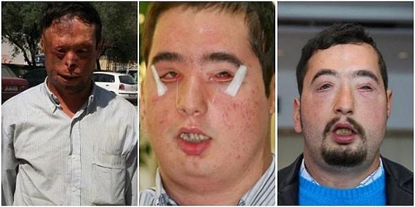 21. 3,5 yaşında ocağa düşmesi sonucu yüzünün yanmasıyla hayatı değişen Turan Çolak.