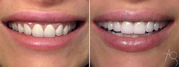 5. Diş teli etkisini diş kaplama yöntemiyle de elde edebiliyorsunuz.