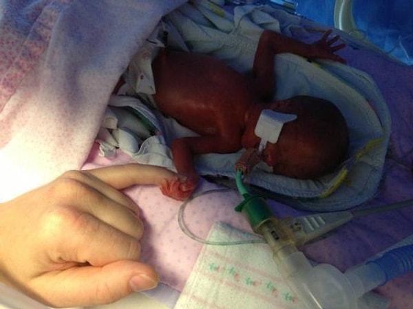 1. gün...Küçük bebek Edie düşünüldüğü tarihten çok çok önce dünyaya geldi ve sadece 570 gramdı...