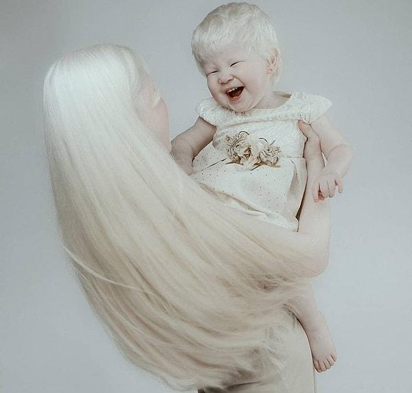 Aralarında tam 12 yaş var, fakat ikisi de albino olarak doğdular.