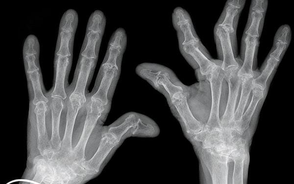 8. Romatoid artrit