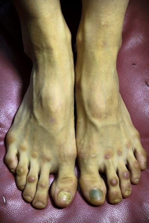 Enfeksiyona dönüşen ayak mantarı, kangrene neden olacak bir boyuta gelebilmektedir de...