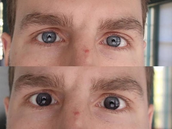 9. Контактные линзы до и после того как выйти на солнце: