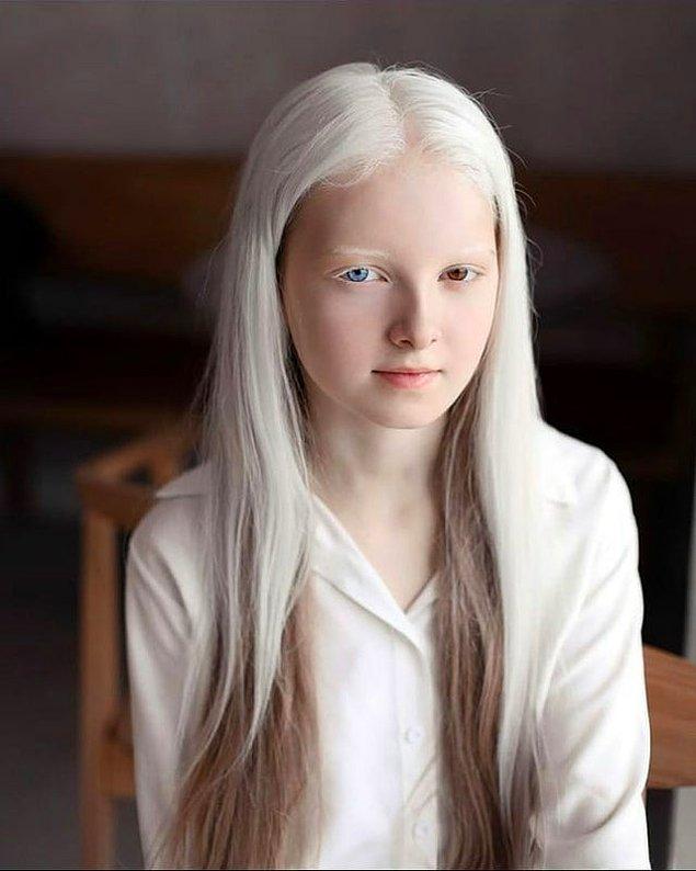 5. Albino ve heterokromi olan bir kız