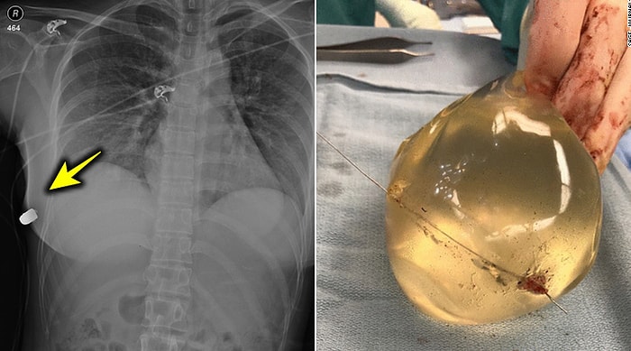 Yakın Mesafeden Atılan Merminin Meme Silikonlarına Denk Gelmesi Sonucu Hayatı Kurtulan Kadın