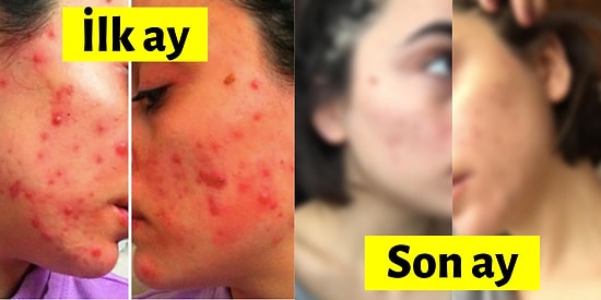 Maddi ve Manevi İliğimi Kurutan Sivilce Tedavimin Son Ayındayım! İlk ve Son Halimi Karşılaştırınca Gözlerime İnanamadım!