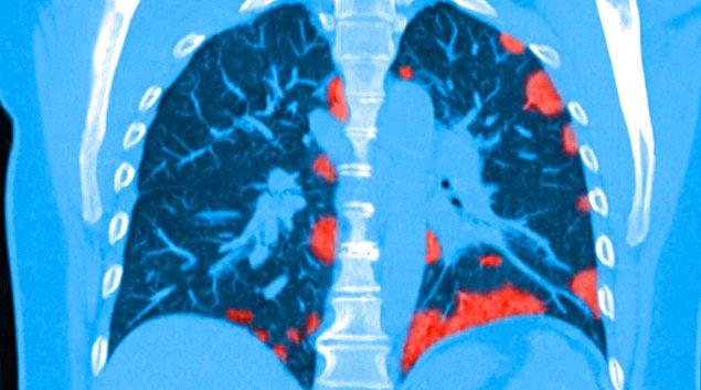 Uzmanlar Covid-19'dan iyileşen hastaların bazılarında, akciğerlerindeki hasarın kalıcı olabileceği söylüyorlar.