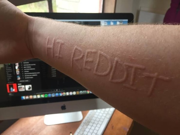 7. «У меня дерматография, а это значит, что я могу «рисовать» на своей коже».