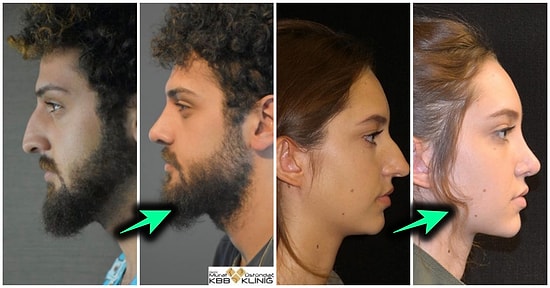 Geçirdikleri Burun Estetiği Operasyonundan Sonra Adeta Yeni Bir Yüze Kavuşup Herkese Şok Yaşatan 19 Kişi