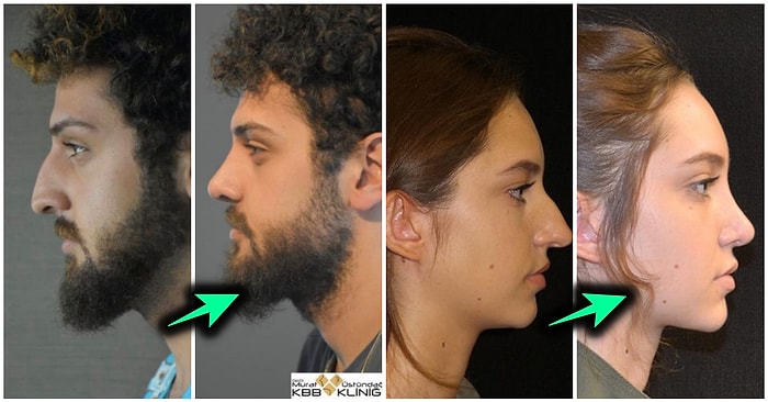 Geçirdikleri Burun Estetiği Operasyonundan Sonra Adeta Yeni Bir Yüze Kavuşup Herkese Şok Yaşatan 19 Kişi