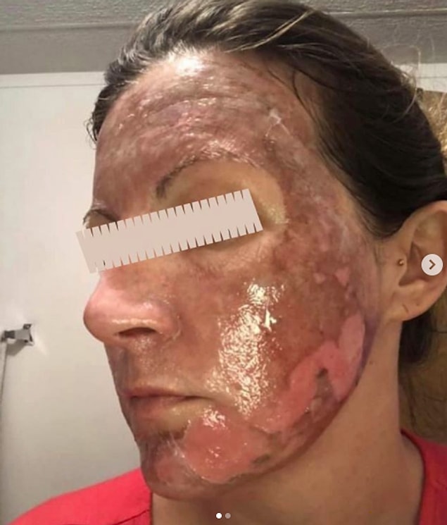 BuzzFeed News ile röportaj yapan Zoe, bu sırada kötü sonuçlarla karşılaşmış insanların fotoğraflarını başkalarına ders olması için paylaştı.