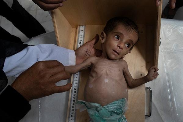 13. 11 aylık Wadah Askri Mesheel, yetersiz beslenmeden dolayı hastaneye yatırıldıktan sekiz saat sonra hayatını kaybetti.