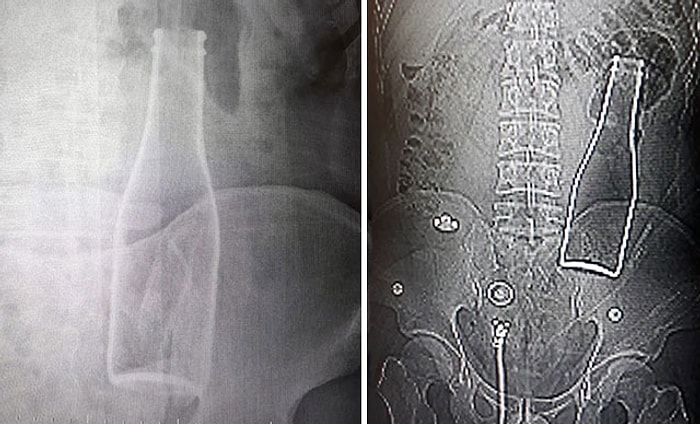 Karın Ağrısı Şikayetiyle Hastaneye Giden Adamın Vücudundan Soda Şişesi Çıkarıldı