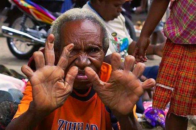 Bu kabilede yaşayan kadınlar, kocaları öldükten sonra yas tutmak için el parmaklarını kesiyor.