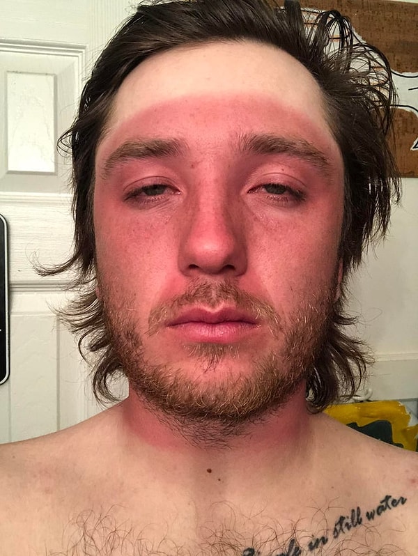 9. "За день до первой встречи с моей девушкой мое лицо было в таком состоянии."