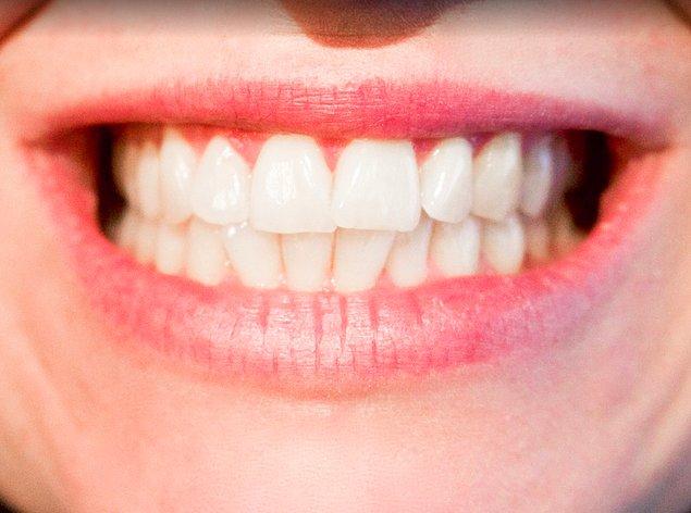 8. Diş yapılarının bozulması: