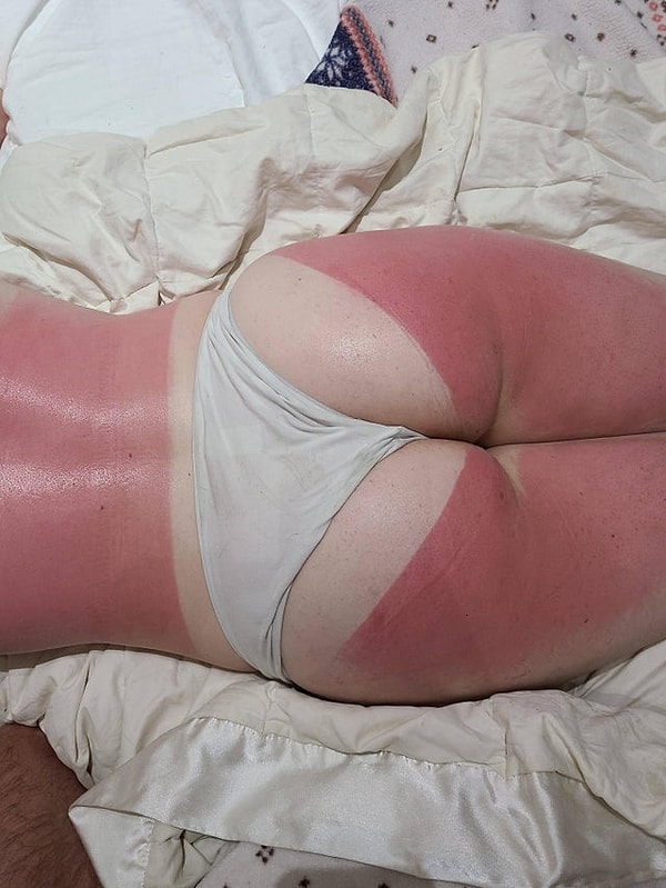 4. «Моя девушка забыла о солнцезащитном креме».