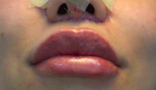 Genellikle dudak kaldırma operasyonundan sonra uzmanlar, burnun alt kısmında iz kalmadığını söylüyor. Çünkü izler, burun altındaki doğal derinin altına gizleniyor ve zamanla bağlantılı deri görünümünün rengini alıyor. Genellikle kalıcı olmayan dikişler kullanılıyor ve yaklaşık bir hafta sonra alınıyor.