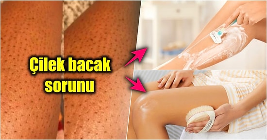 Bebek Poposu Gibi Bacaklar Hayal Ederken Çilek Bacak Sorunu Yaşayanların Yüzünü Güldürecek Tedavi Yöntemlerini Açıklıyoruz!