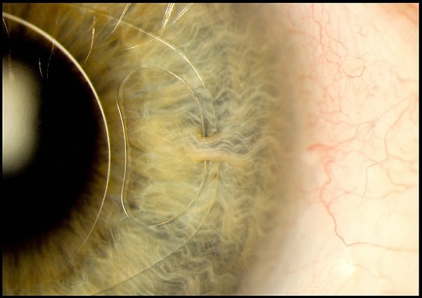 14. Имплант интраокулярной линзы