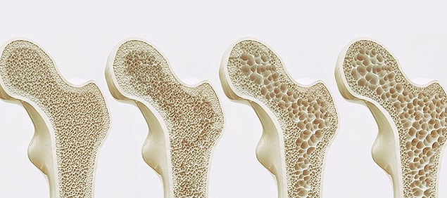 65 yaşın altındaki kadınların özellikle risk faktörleri varsa (sigara içmek, yeterince kalsiyum tüketmemek, ailede osteoporoz öyküsü olması veya düşük kiloda olmak) kemik yoğunluğu testi (dansitesi) tavsiye ediliyor.