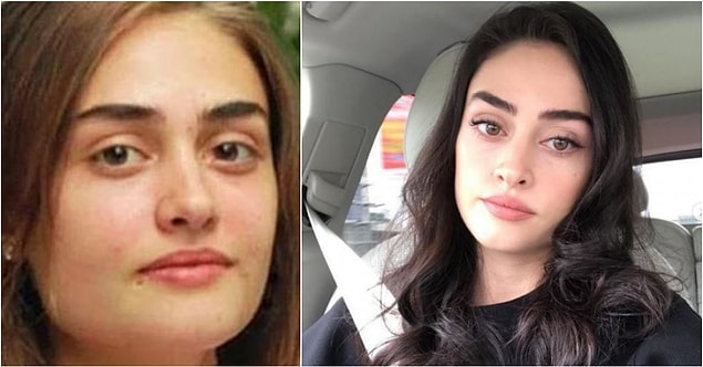Genç oyuncu Esra Bilgiç'in eski fotoğrafları ortaya çıkınca, estetik iddialarının ardı arkası kesilmemişti...