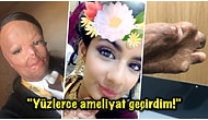 Kullandığı Bit Şampuanı Alev Alınca Yüzü ve Vücudunun Yarısından Fazlası Yanan 16 Yaşındaki Talihsiz Kız
