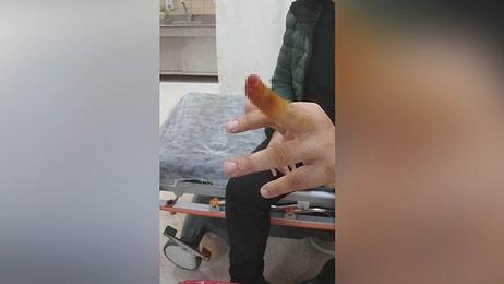 Samsun'da Bir Hasta Yakını Tartıştığı Güvenlik Görevlisinin Parmağını Isırıp Kopardı