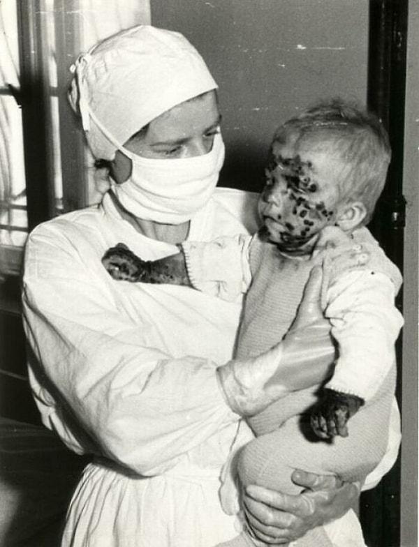 18. 1963 yılında Polonya'da çiçek hastalığına yakalanan bir çocuk ve hemşire.