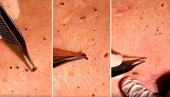 İzlemekten Zevk Alanlara Dev Hizmet: Hipnotize Edici Özelliğiyle Siyah Nokta Sıkma Görüntüleri