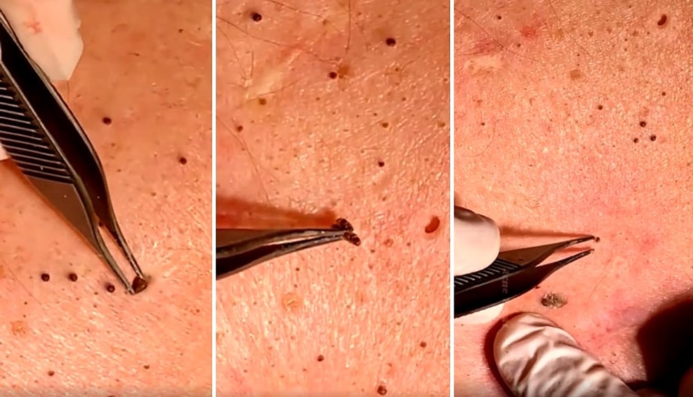 İzlemekten Zevk Alanlara Dev Hizmet: Hipnotize Edici Özelliğiyle Siyah Nokta Sıkma Görüntüleri