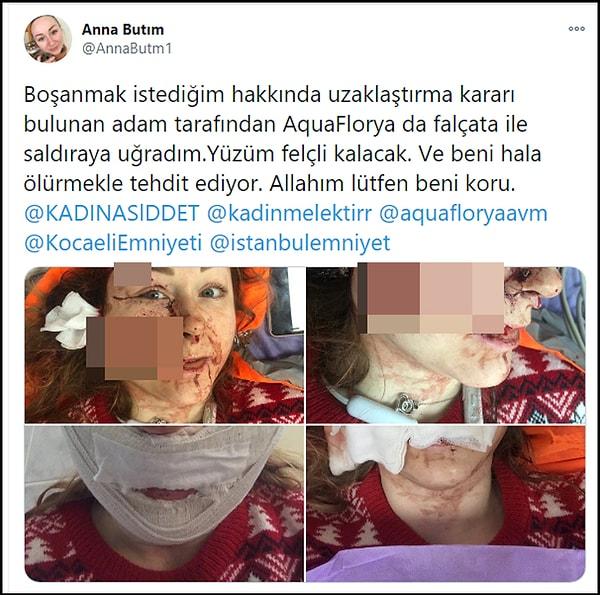 Falçata ile yüzü parçalanan Butim, yüzünde açılan derin yaraları sosyal medyadan paylaşarak yardım istedi.